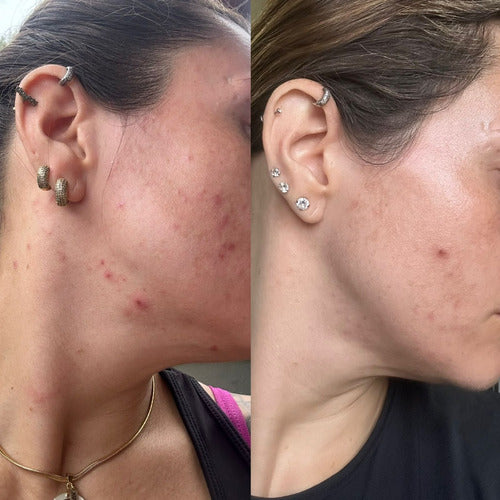 Facial Faces Healthiz com Ácido Hialurônico – 180 Dias